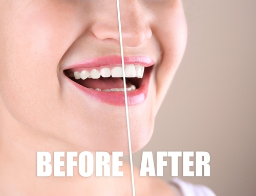 gum contouring before and afer